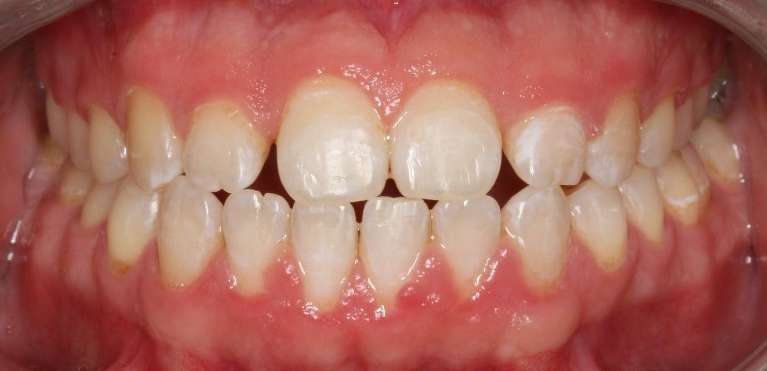 clear aligners in South Charlotte- Before