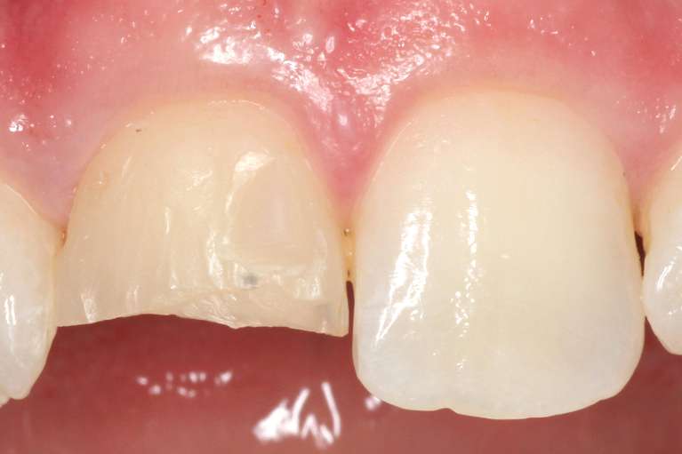 Before Dental Veneers