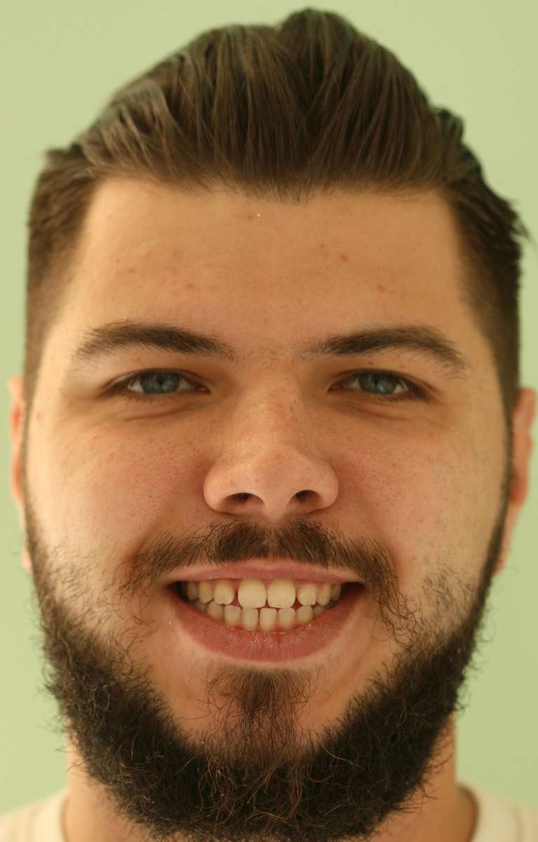 clear aligners in Charlotte- Before