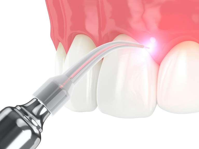 laser dentistry tool